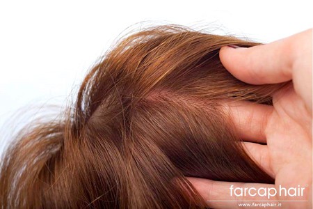 Protesi capelli 3D