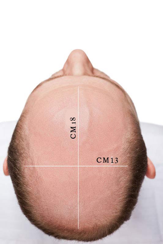 protesi capelli hr 5