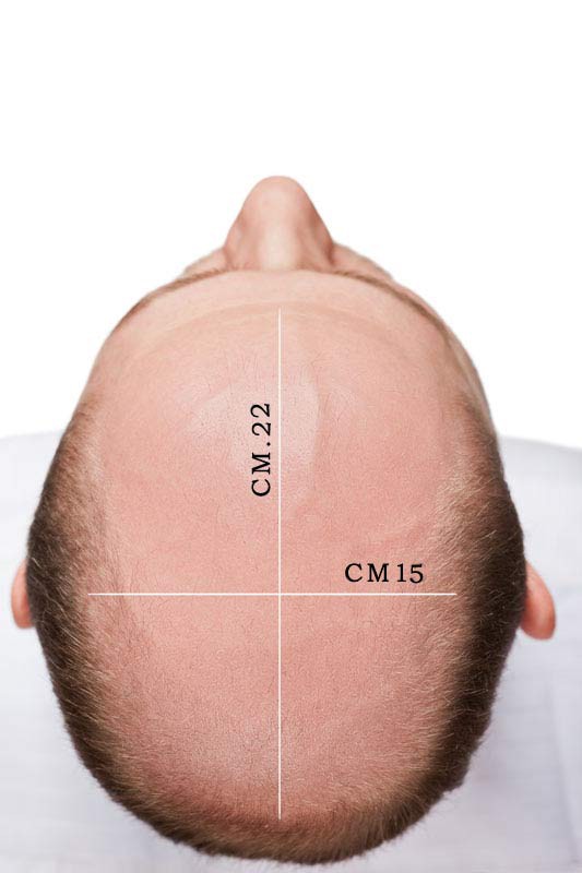 protesi capelli hr 2