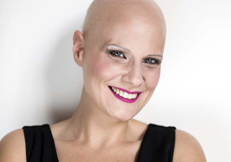 alopecia